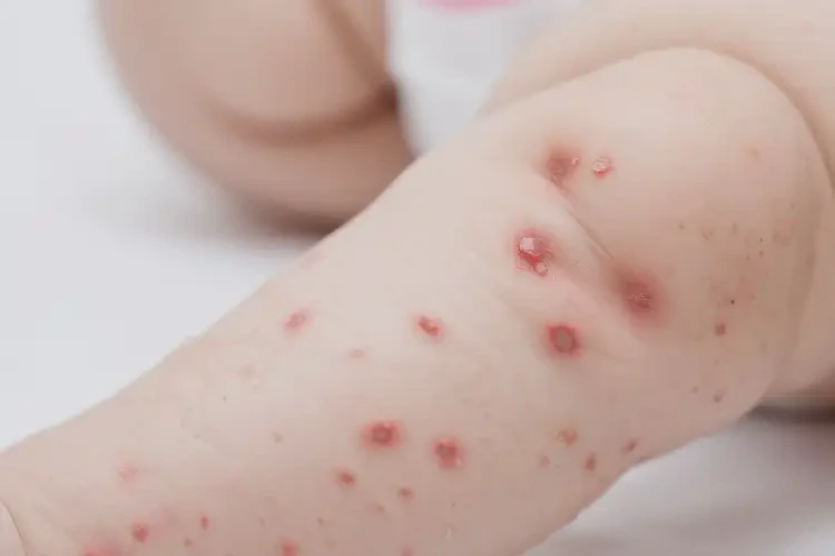 寶寶小腿上經(jīng)常起濕疹不管它會自己痊愈嗎(圖4)