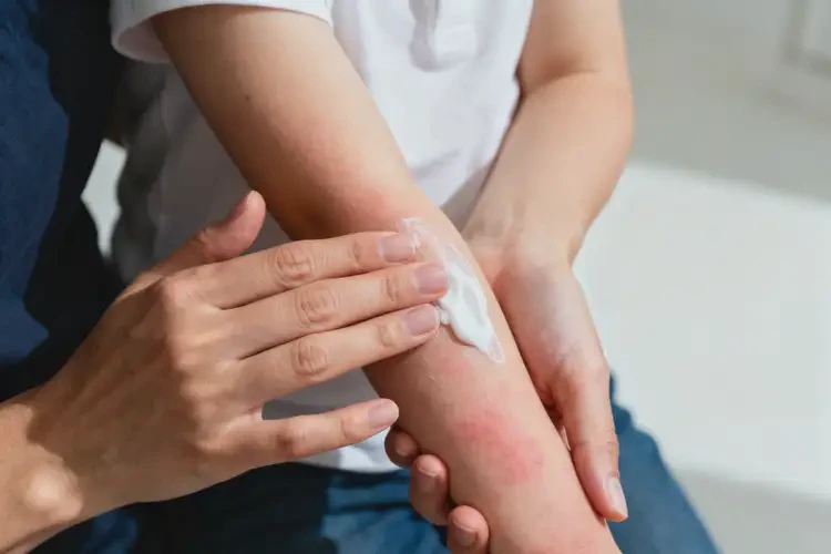 小儿手臂上出湿疹不管它会自己自愈吗(图3)