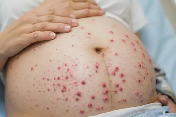 產(chǎn)婦肚子上長(zhǎng)濕疹能靠自己自愈嗎(圖4)