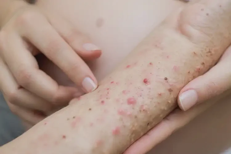 孕婦手臂偶爾長濕疹能靠自己自愈嗎(圖4)