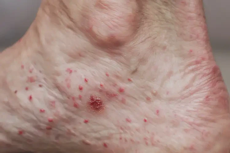 哺乳期媽媽腳上經(jīng)常起濕疹不管它會自己自愈嗎(圖3)