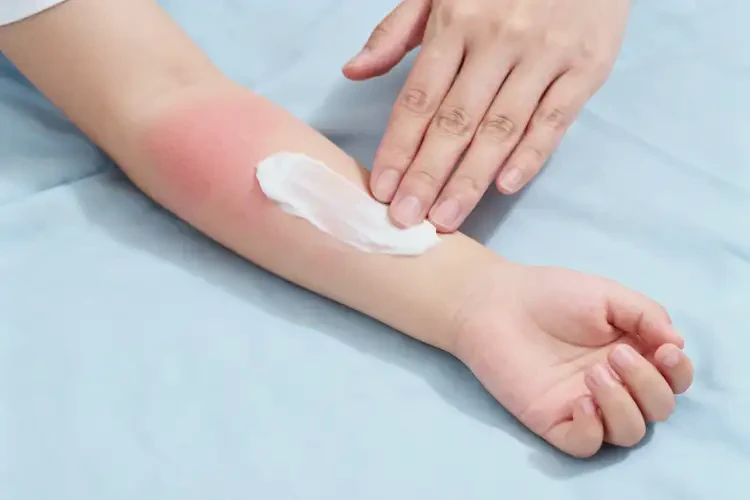 兒童手臂經(jīng)常起濕疹不管它會自己自愈嗎(圖4)