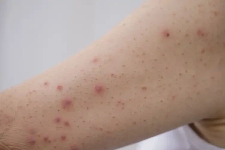 女人全身偶爾長濕疹能不能徹底自愈(圖3)