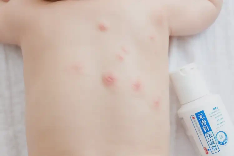 小孩身上出濕疹能靠自己自愈嗎(圖4)