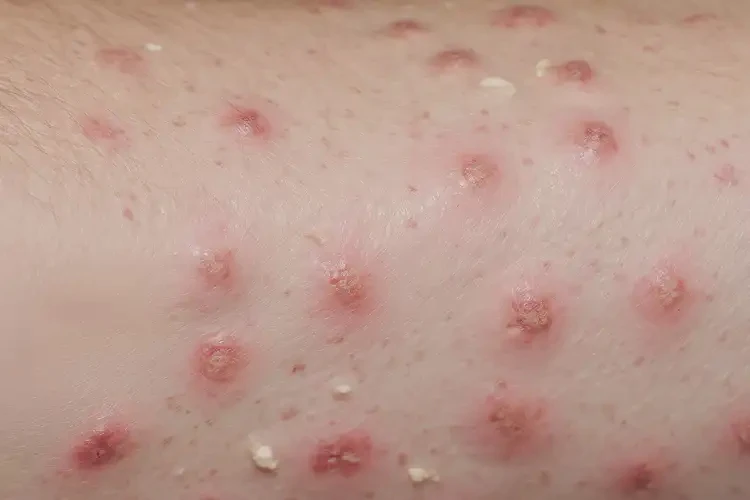 小學生身上容易起濕疹不管它會自己自愈嗎(圖2)