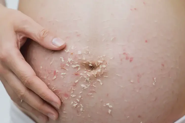 孕妇屁股出湿疹能靠自己自愈吗(图4)