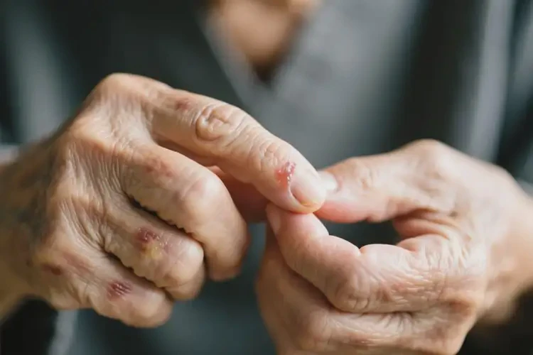 高齡老人手臂上有濕疹不管它會自己好嗎(圖1)