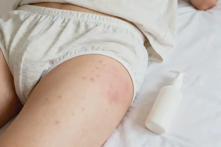青年人屁股上有濕疹不管它會自己好嗎(圖3)