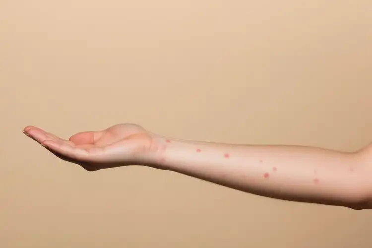 女人手臂有濕疹不管它會自己自愈嗎(圖3)