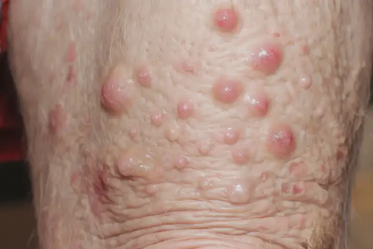 老人大腿容易起濕疹不管它會(huì)自己自愈嗎(圖4)