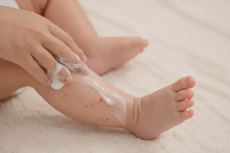 嬰幼兒大腿有濕疹可以徹底自愈嗎(圖2)