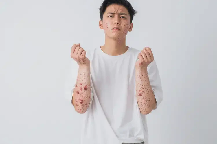 男生全身出濕疹能靠自己自愈嗎(圖4)