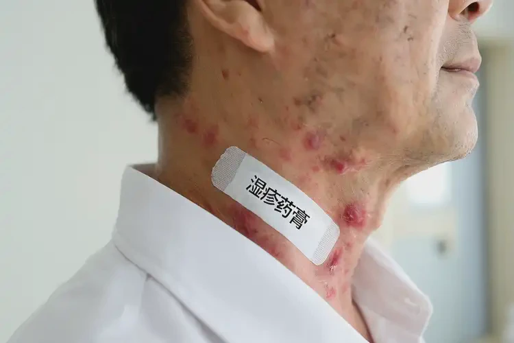 男性脖子上偶爾長濕疹能夠徹底治愈嗎(圖4)