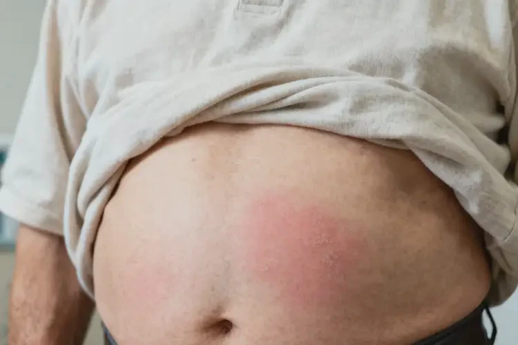 老年人肚子長濕疹不管它會自己自愈嗎(圖1)