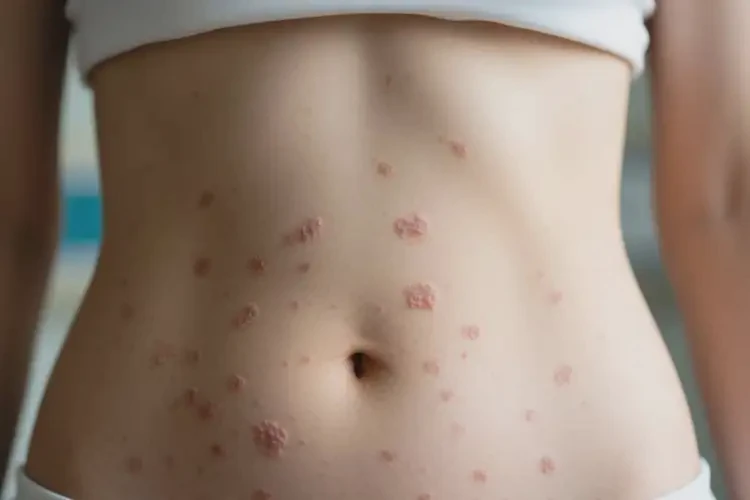 女人肚子上偶爾起濕疹可以徹底自愈嗎(圖4)