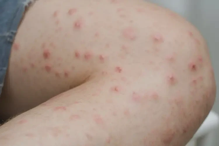 青年人大腿上經(jīng)常長濕疹能不能徹底自愈(圖4)