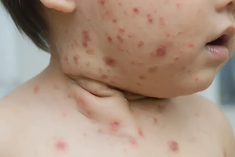 孩子脖子上容易長濕疹不管它會自己痊愈嗎(圖4)