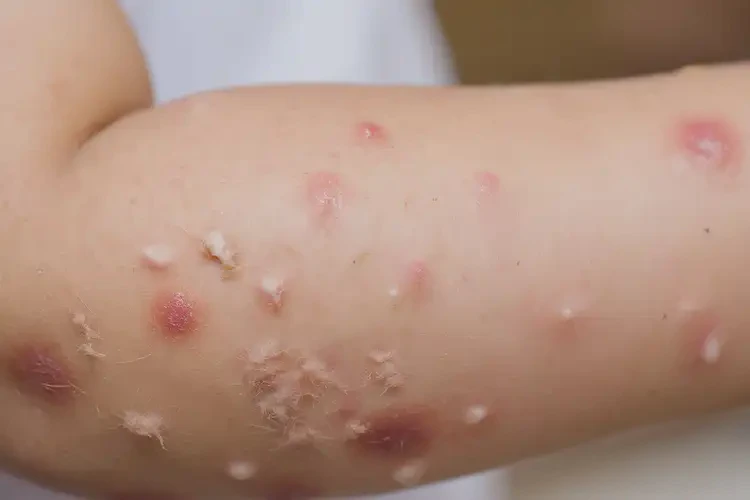 小学生手臂有湿疹能靠自己自愈吗(图4)