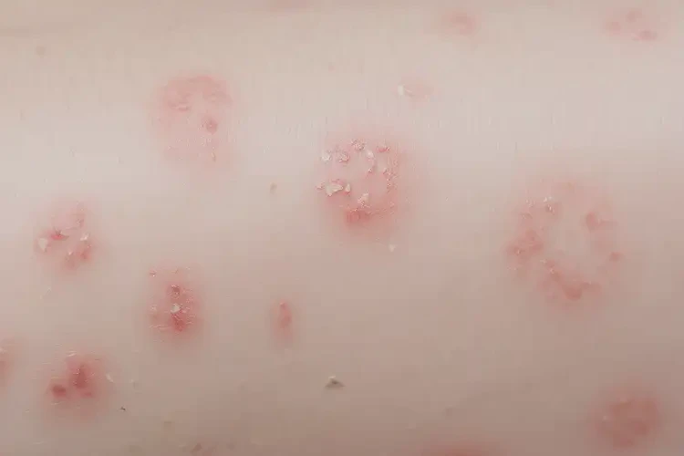 寶寶大腿上經(jīng)常起濕疹不管它會自己痊愈嗎(圖4)