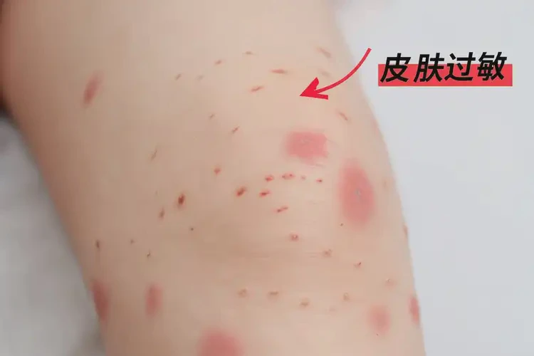 孩子大腿上容易長(zhǎng)濕疹能徹底自愈嗎(圖4)