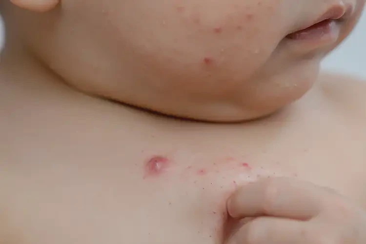 幼兒脖子容易起濕疹可以徹底自愈嗎(圖4)