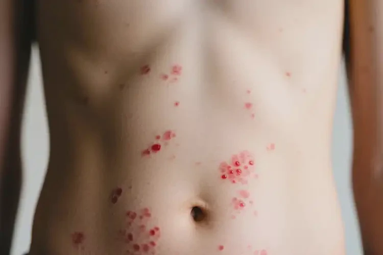 中學生肚子偶爾長濕疹可不可以徹底自愈(圖4)