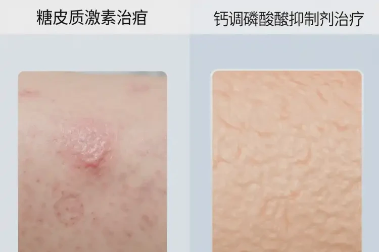 老年人腳上出濕疹可不可以徹底自愈(圖2)