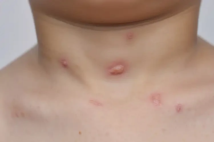 兒童脖子上偶爾長濕疹不管它會自己好嗎(圖4)