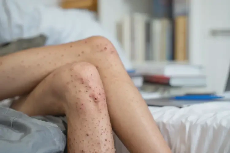 大學(xué)生小腿偶爾起濕疹不管它會(huì)自己自愈嗎(圖4)