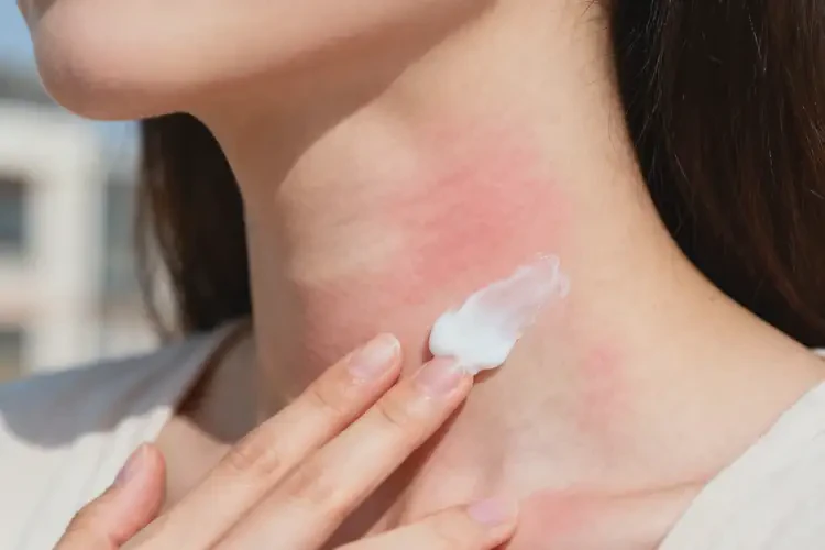 哺乳期媽媽脖子上偶爾長(zhǎng)濕疹能徹底自愈嗎(圖1)