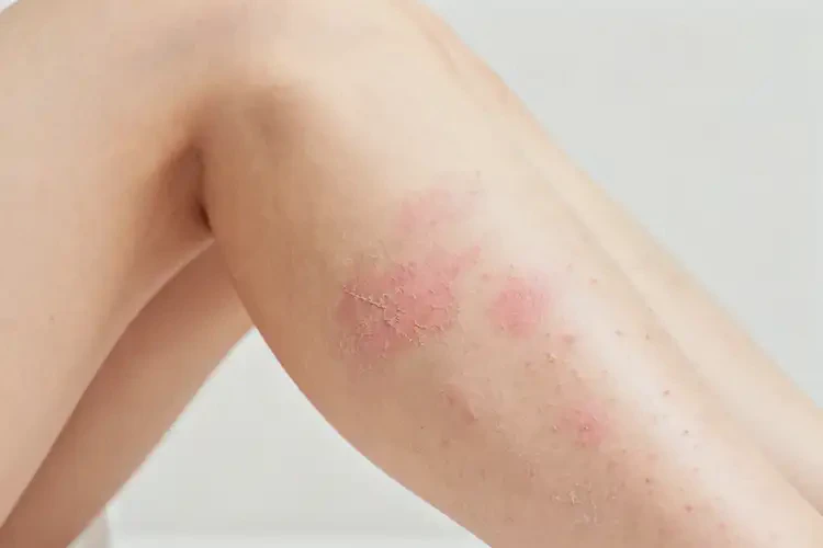 女人小腿出湿疹不管它会自己痊愈吗(图2)