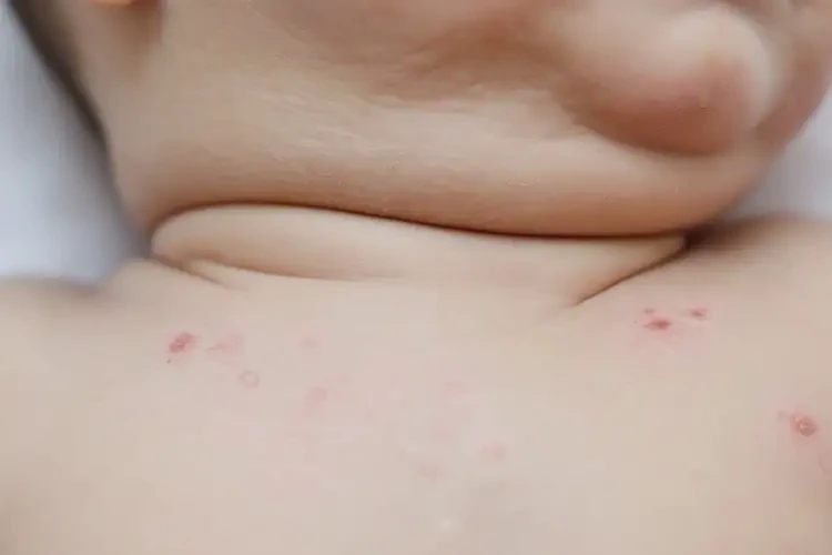 小儿脖子偶尔长湿疹能彻底自愈吗(图4)