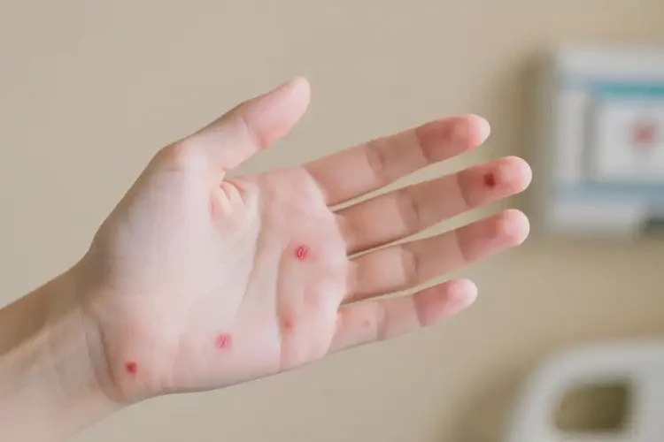 女性手上偶爾長(zhǎng)濕疹能徹底自愈嗎(圖4)