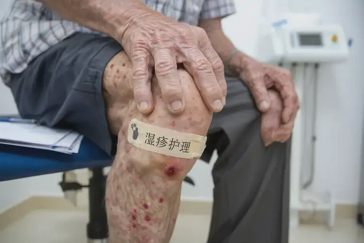 老人大腿容易起濕疹能徹底自愈嗎(圖4)