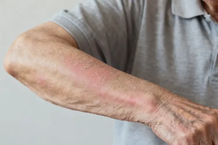 高齡老人手臂上經(jīng)常長濕疹能徹底自愈嗎(圖2)