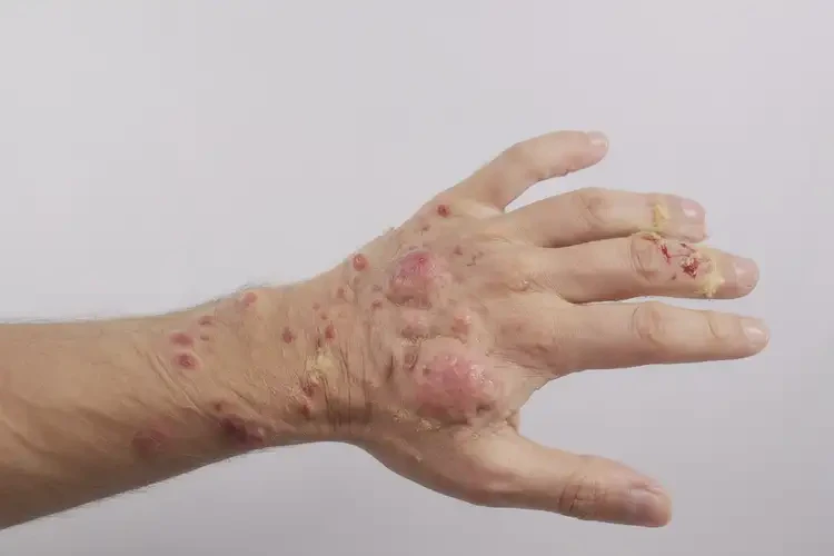 男性手上偶爾起濕疹不管它會自己自愈嗎(圖3)