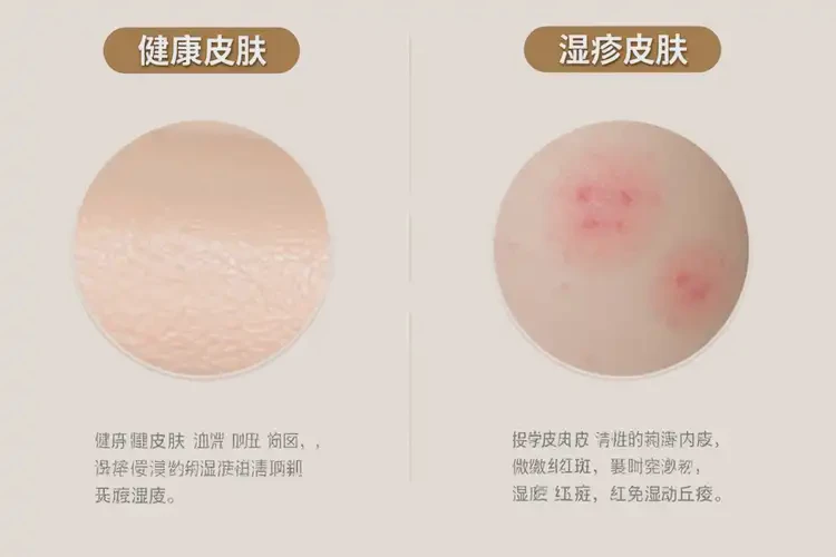 男生大腿上出現(xiàn)濕疹不管它會(huì)自己好嗎(圖1)