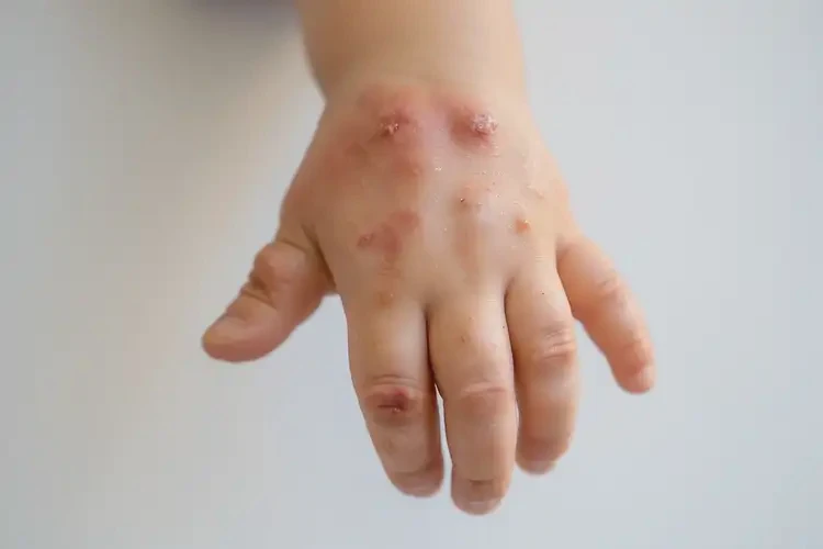兒童手上偶爾起濕疹能徹底自愈嗎(圖3)