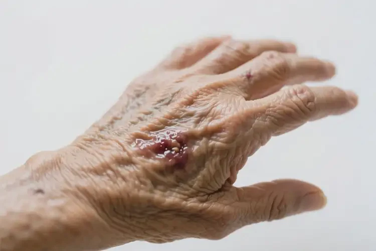 高齡老人身上出現(xiàn)濕疹不管它會(huì)自己痊愈嗎(圖2)