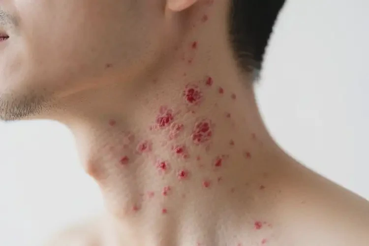 男性脖子上長濕疹可以徹底自愈嗎(圖4)