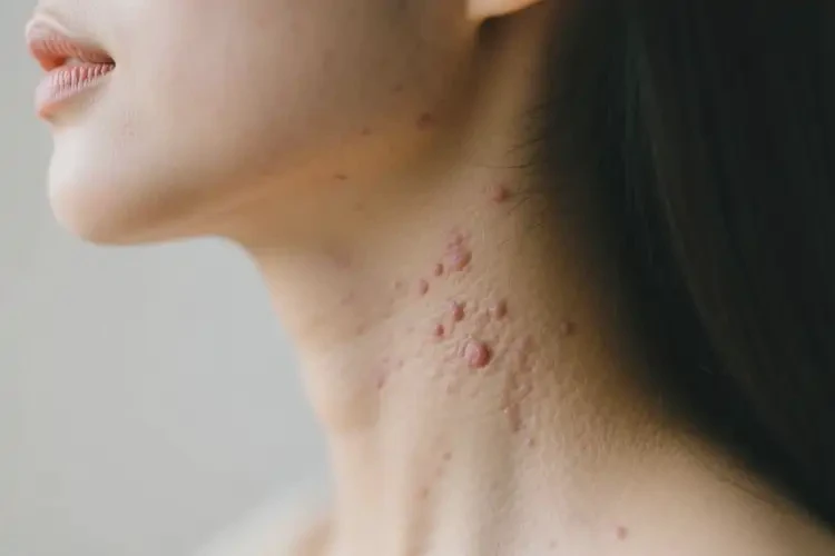 女性脖子上容易起濕疹不管它會(huì)自己好嗎(圖1)