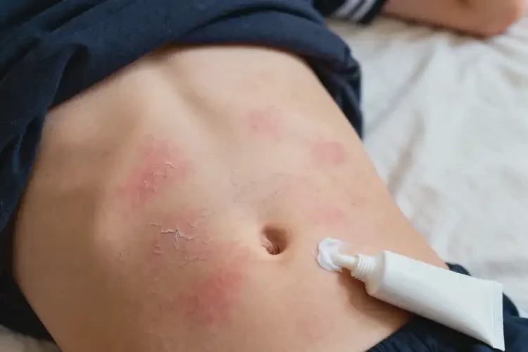 中學生肚子有濕疹能夠徹底治愈嗎(圖1)