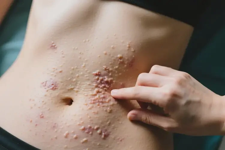 女性肚子出濕疹不管它會(huì)自己自愈嗎(圖1)