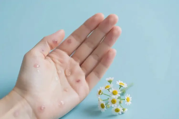 女性手上偶爾長(zhǎng)濕疹能徹底自愈嗎(圖2)