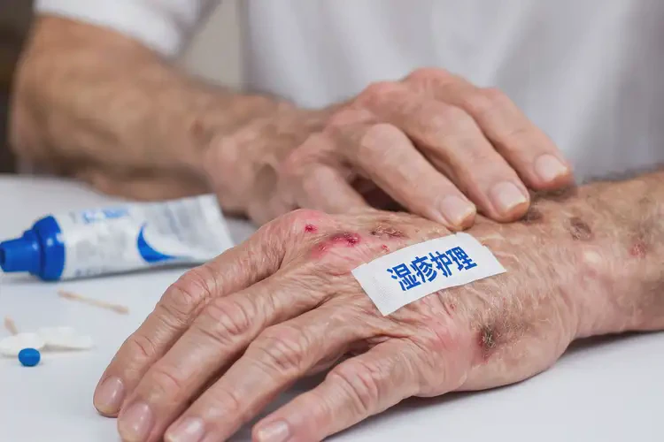 老人手上出濕疹可以徹底自愈嗎(圖4)