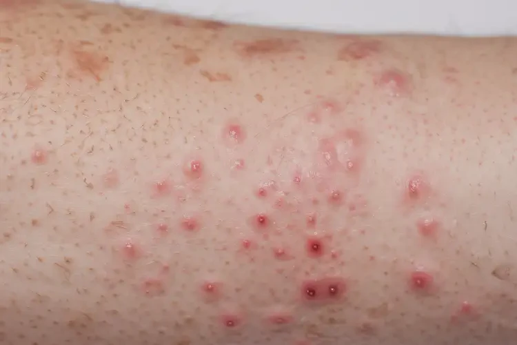 女生腳上起濕疹可不可以徹底自愈(圖4)