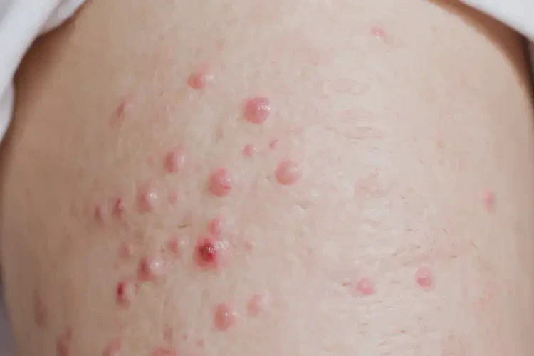 產(chǎn)婦小腿出現(xiàn)濕疹可不可以徹底自愈(圖4)