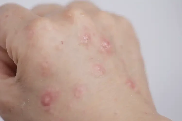 孩子手上長濕疹能夠徹底治愈嗎(圖4)