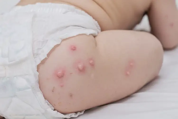 小兒屁股上容易長濕疹不管它會(huì)自己好嗎(圖4)