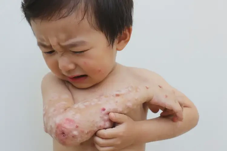 小孩全身出濕疹可以徹底自愈嗎(圖4)